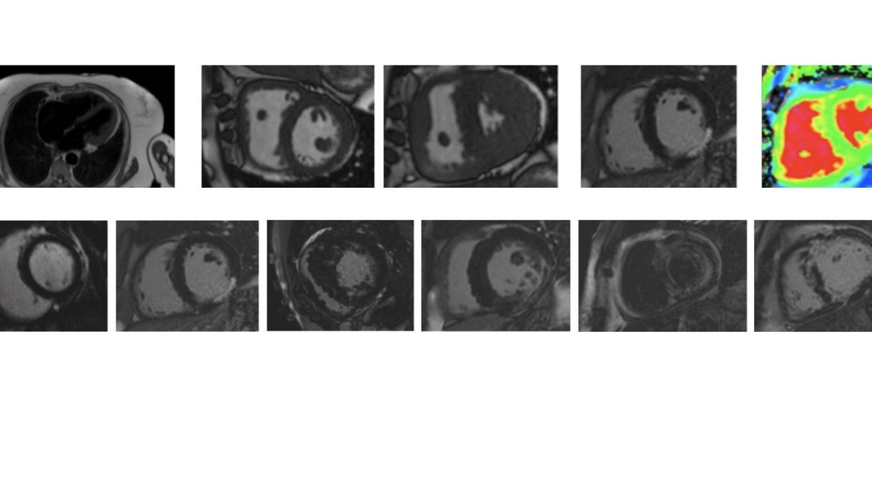 Kardiale Magnetresonanztomografie Ihre St Rken Und Schw Chen